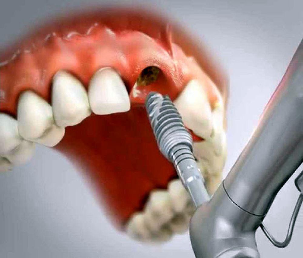 Implantes