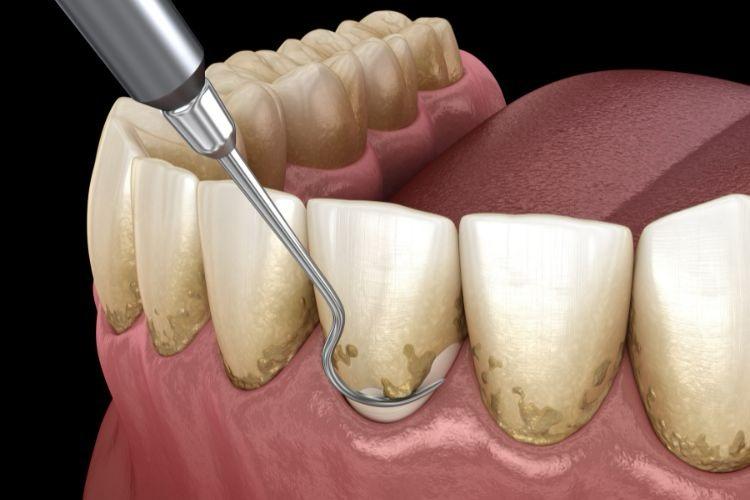 Tratamento Periodontal